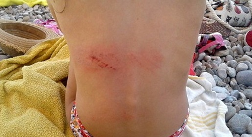 Восьмилетняя девочка получила травму спины на необорудованном пляже в Коктебеле (ФОТО)