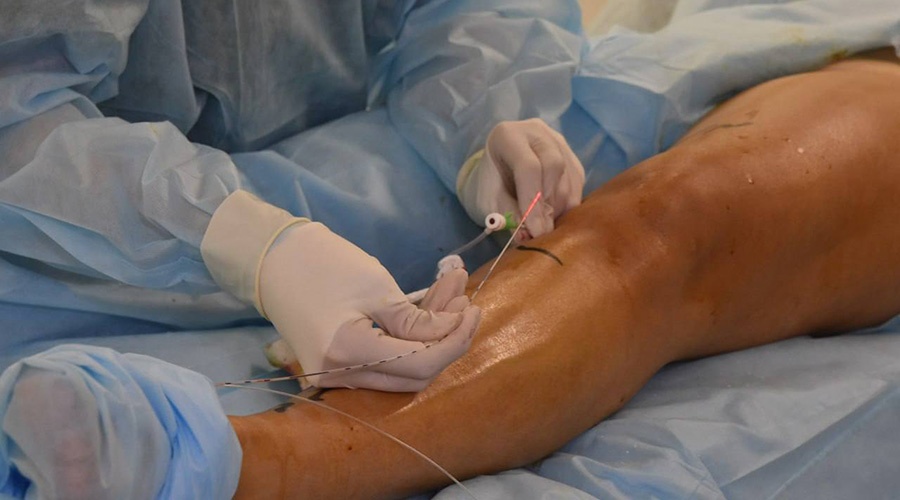 Лазерное оборудование для лечения варикозной болезни поступило в крымскую больницу