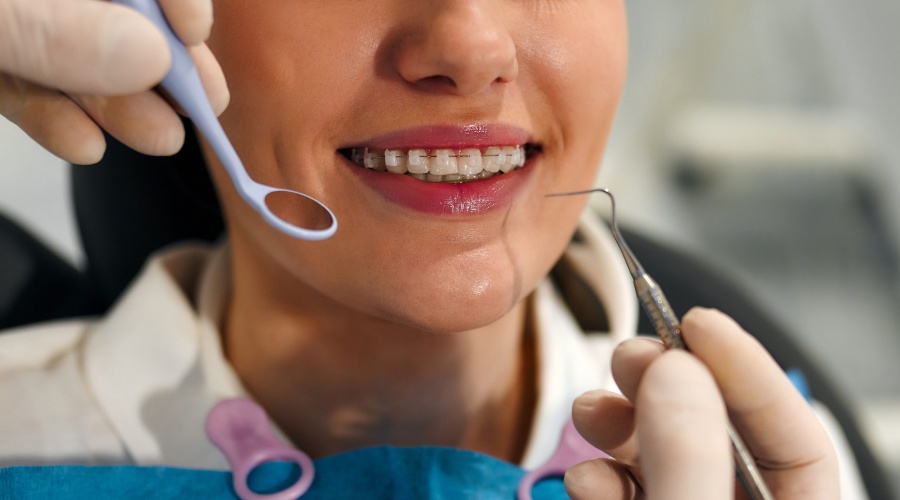 Керамические брекеты: Эстетика и эффективность ортодонтического лечения