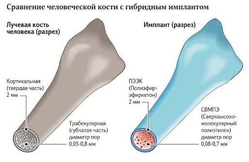 Российские ученые создали идентичный человеческой кости имплант